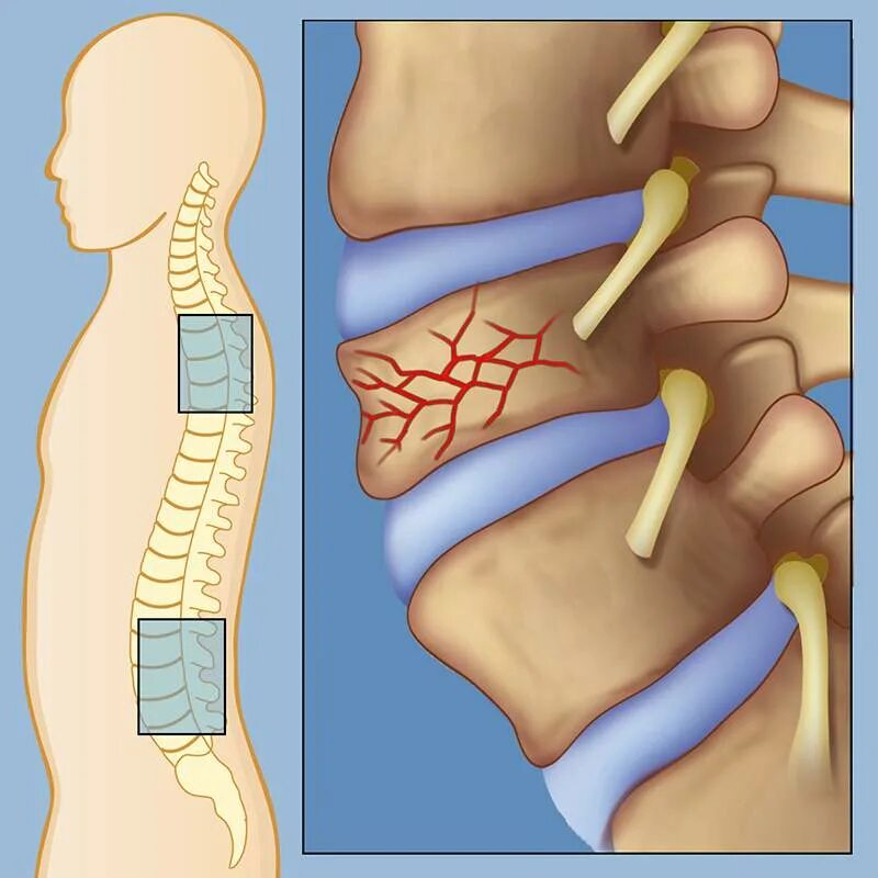 Травма поясничного отдела позвоночника. Компрессионный перелом позвоночника т12. Компрессионный перелом тела т11 позвонка. Компрессионный перелом т12 позвонка позвоночника. Компрессионный перелом позвоночника th11-l1.