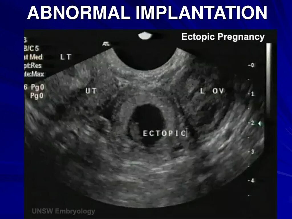 Внематочная беременность на УЗИ фото. УЗИ беременности внематочная внематочная беременность. Внематочная Трубная беременность фото. УЗИ внематочной беременности на раннем сроке фото.