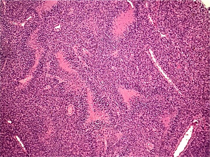 глиобластома гистологическая картина. злокачественная менингиома гистология. анапластическая карцинома гистология. ангиоретикулома гистология. олигодендроглиома гистология.