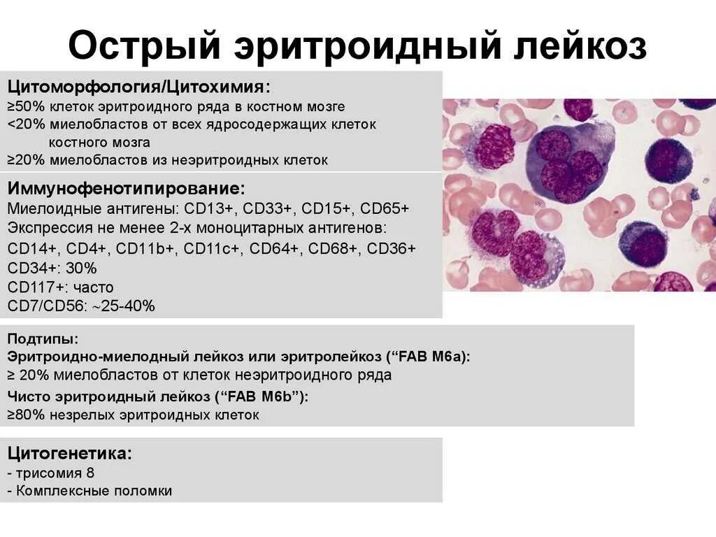 Злокачественные заболевания крови. Острый миелобластный лейкоз гистология. Острый недифференцированный лейкоз костный мозг. Острый миелоидный лейкоз исследования крови. Острый миелоидный лейкоз картина крови.