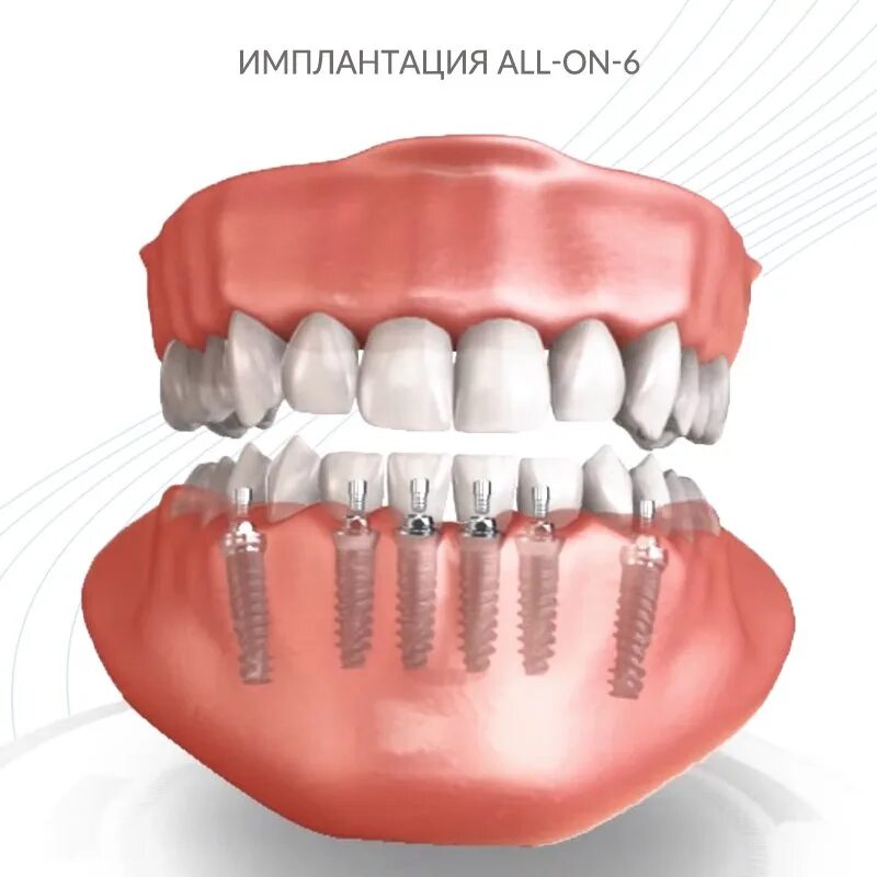 Имплантация зубов all on 6. Имплантация зубов по технологии all-on-6 ("все на шести").. Имплантация зубов по технологии «all on 4». Имплантация челюсти на 6 имплантах.