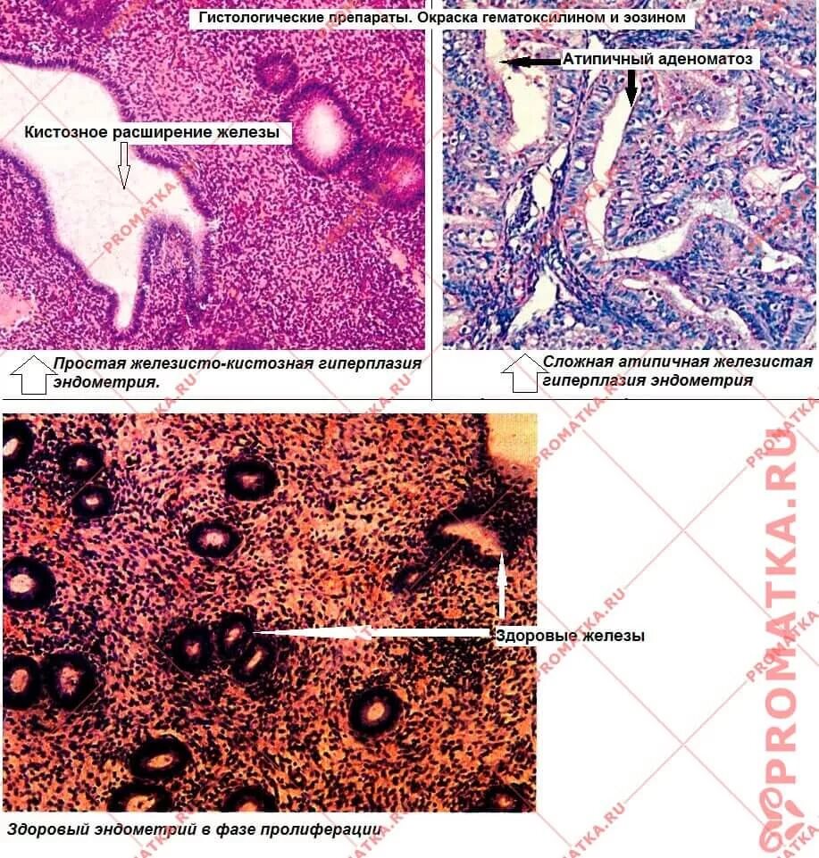 Атипическая гиперплазия гистология. Железистая гиперплазия эндометрия гистология классификация. Фиброматоз яичника гистология. Простая гиперплазия эндометрия гистология. Простая железистая гиперплазия эндометрия