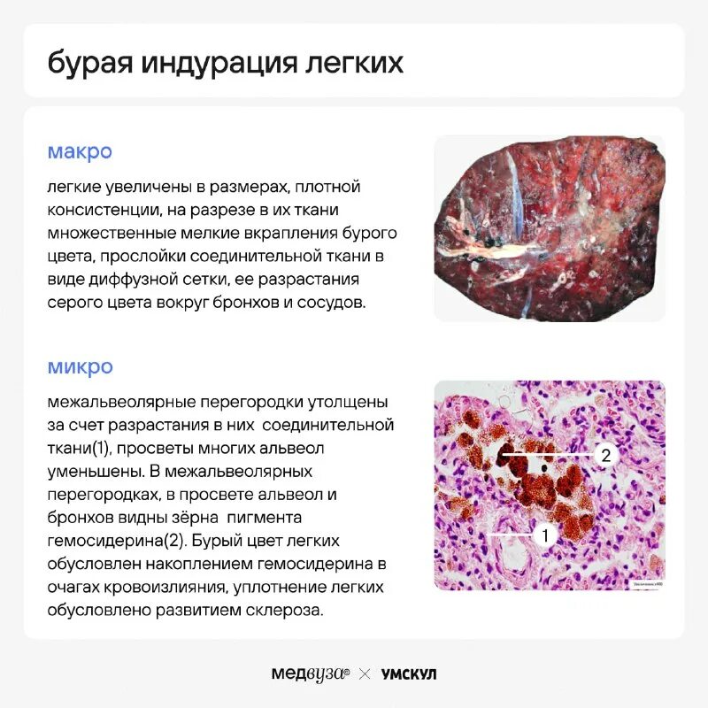 бурая индурация легких это