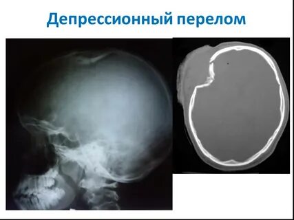 Импрессионный перелом кости