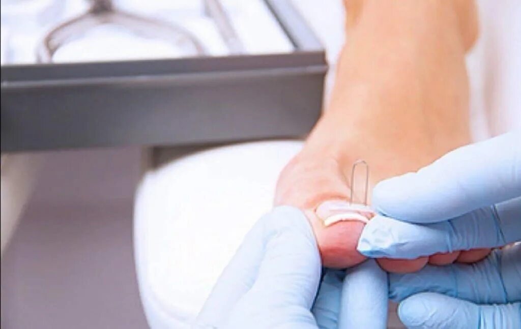 специалист по вросшим ногтям