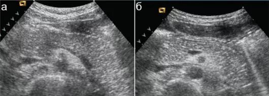 Узи реактивные изменения печени. Липоматоз поджелудочной железы. Липоматоз поджелудочной на УЗИ. Реактивные изменения поджелудочной железы на УЗИ. Липоматоза поджелудочной железы на УЗИ.