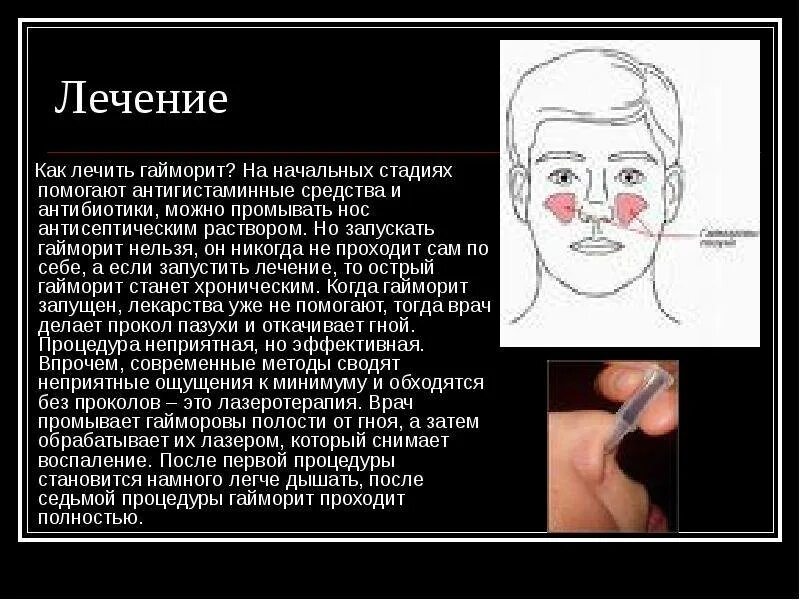 Как понять что у тебя гайморит симптомы. Как понять что у тебя гайморит симптомы