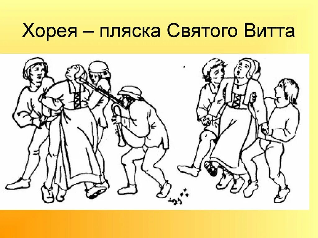 Пляска святого вите. Болезнь Хантингтона пляска Святого Витта. Хореический гиперкинез пляска Святого Витта. Хорея Гентингтона пляска Святого Витта. Болезнь Хорея (пляска Святого Витта),.