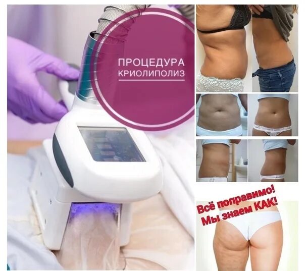 Криолиполиз как работает. Реклама криолиполиза. насадки для криолиполиза. криолиполиз акция.