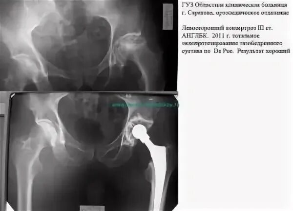 Артроз тазобедренного сустава мкб