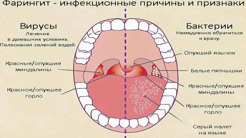 Фарингит эффективное лечение. Инфекционный фарингит.