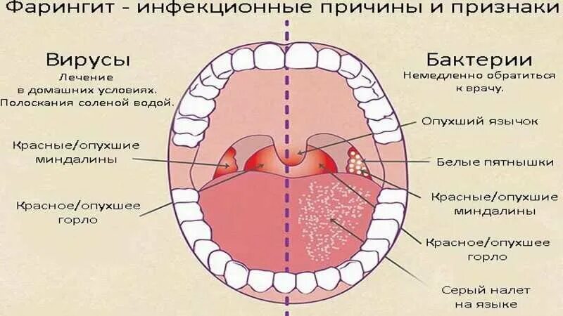 Инфекционный фарингит. Самое эффективное лечение фарингита