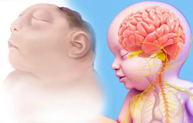 Отсутствие мозга. Отсутствие мозга у новорожденного. Ребенок с отсутствием мозга. Порок развития анэнцефалия.