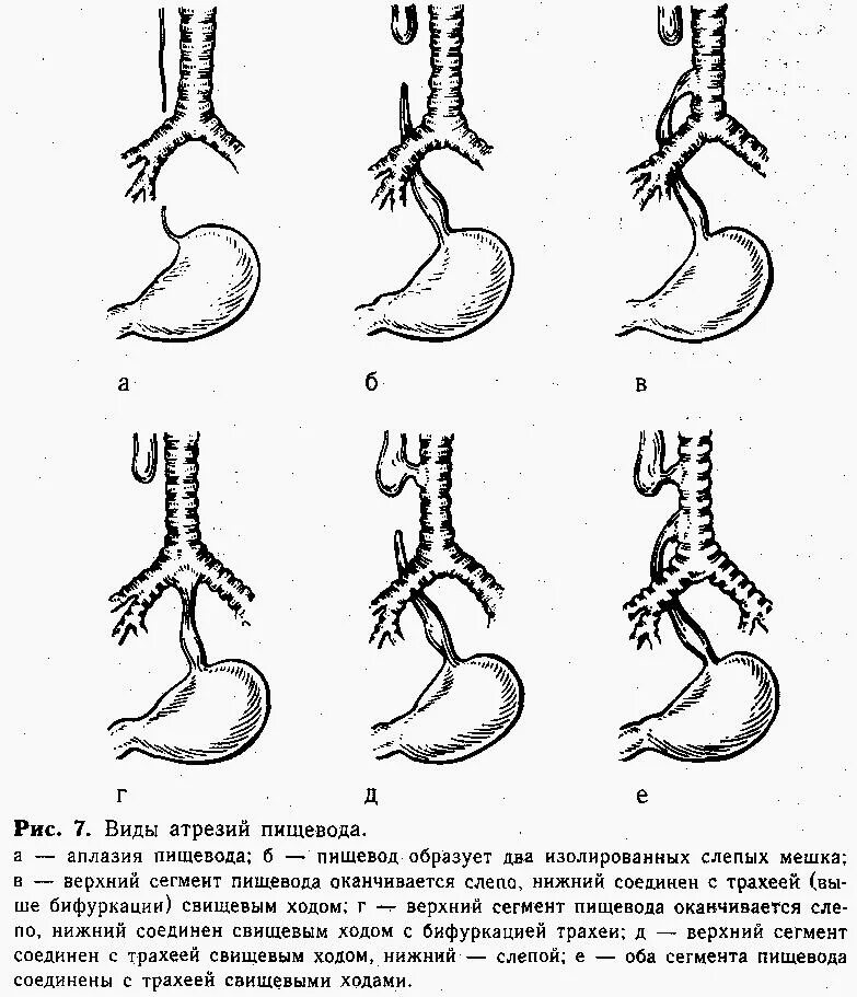 Формирование пищевода. Атрезия пищевода классификация. Анатомические формы атрезии пищевода. Изолированная форма атрезии пищевода. Формы атрезии пищевода у детей.