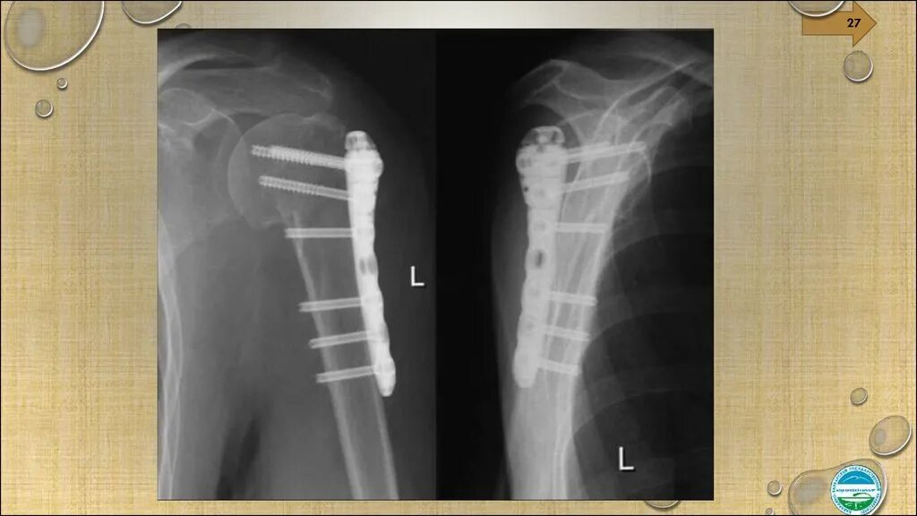 Установлен со смещением. Остеосинтез шейки плеча рентген. Интрамедуллярный остеосинтез штифтом. Супинационный перелом лодыжки. Перелом 5 пястной кости рентген.