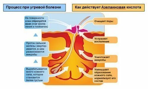 Азелаиновая кислота крем. Азелаиновая кислота действие. Азелаиновая кислота действие. Азелаиновая кислота действие. Азелаиновая кислота действие.