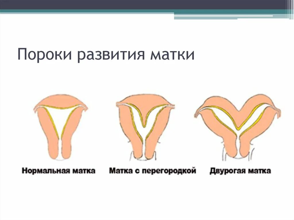 двухроговая матка у женщин. патология матки двурогая матка. двух рогая матка с перегородкой. двурогая матка у женщин. двухроговая матка у женщин.