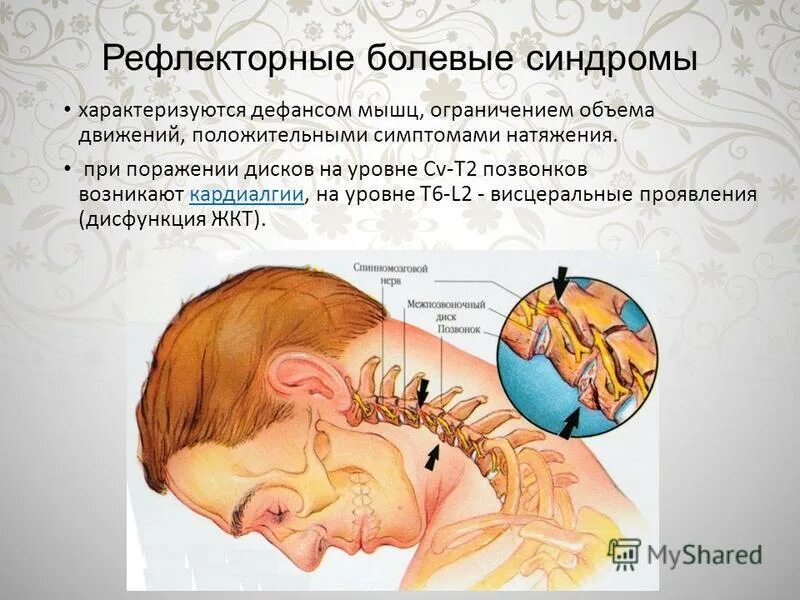 Рефлекторные боли. Признаки рефлекторного болевого синдрома. Шейный рефлекторный синдром. Клинические признаки рефлекторного болевого синдрома. Рефлекторные синдромы шейного отдела.