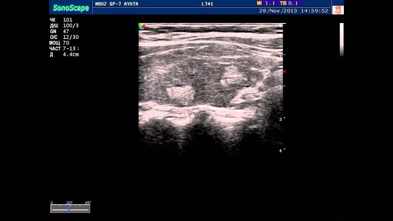 Гиперэхогенный узел в щитовидной железе УЗИ. Гиперэхогенный узел щитовидной железы на УЗИ. Анэхогенный узел щитовидной железы. Узел в щитовидной железе на УЗИ.