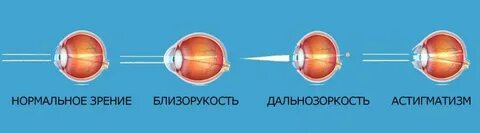 С какого зрения делают коррекцию
