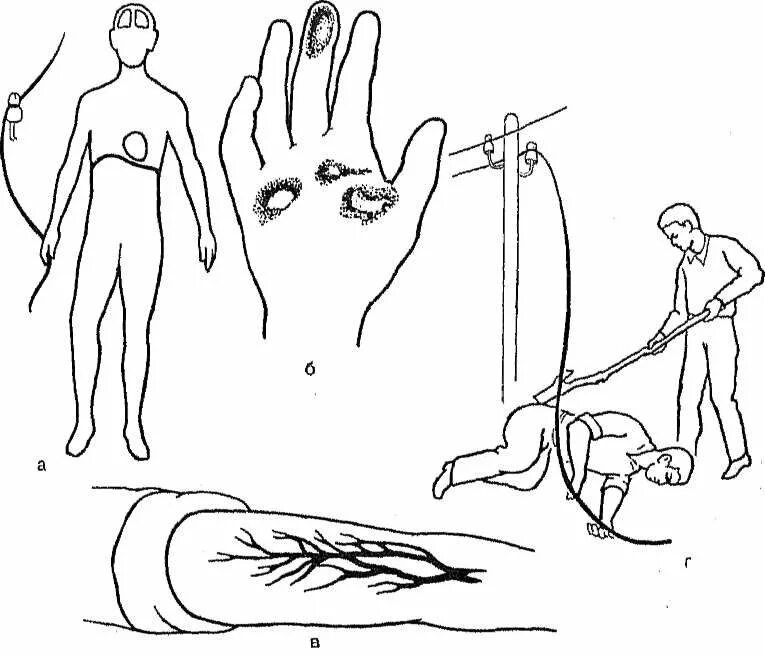 Поражение током симптомы. Электротравма хирургия. Электротравмы поражения электрическим током. Электрические ожоги (поражение электрическим током).. Электрический ожог и электротравма.
