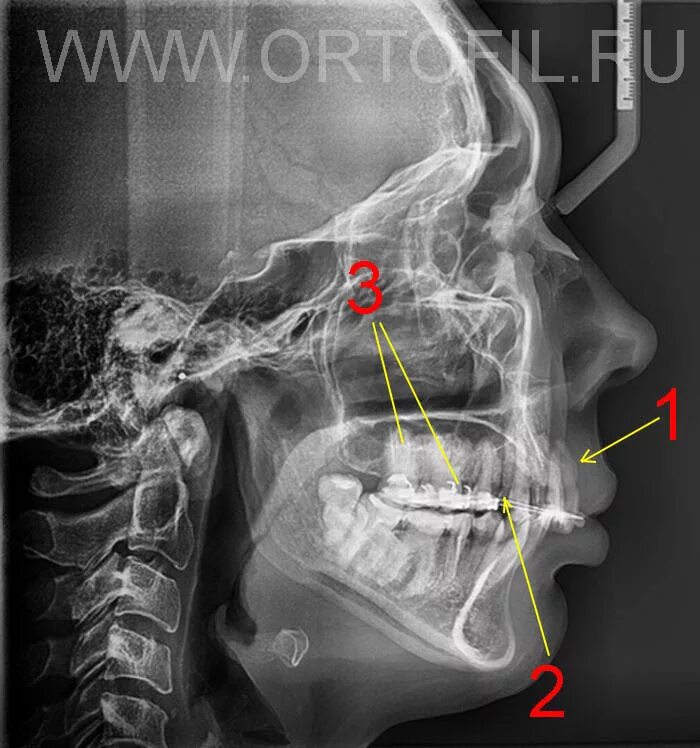 кт в окклюзии