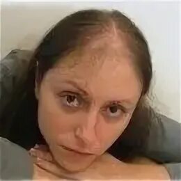 После химиотерапии выпадают