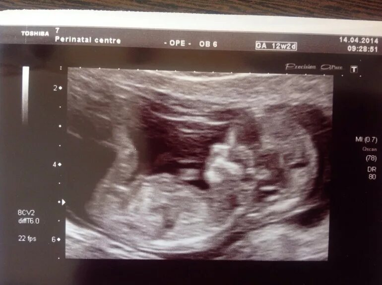 снимок узи 13 недель беременности мальчик. узи 13 недель беременности мальчик. узи пол ребенка фото мальчиков и девочек. ребёнок 14 недель беременности мальчик узи.