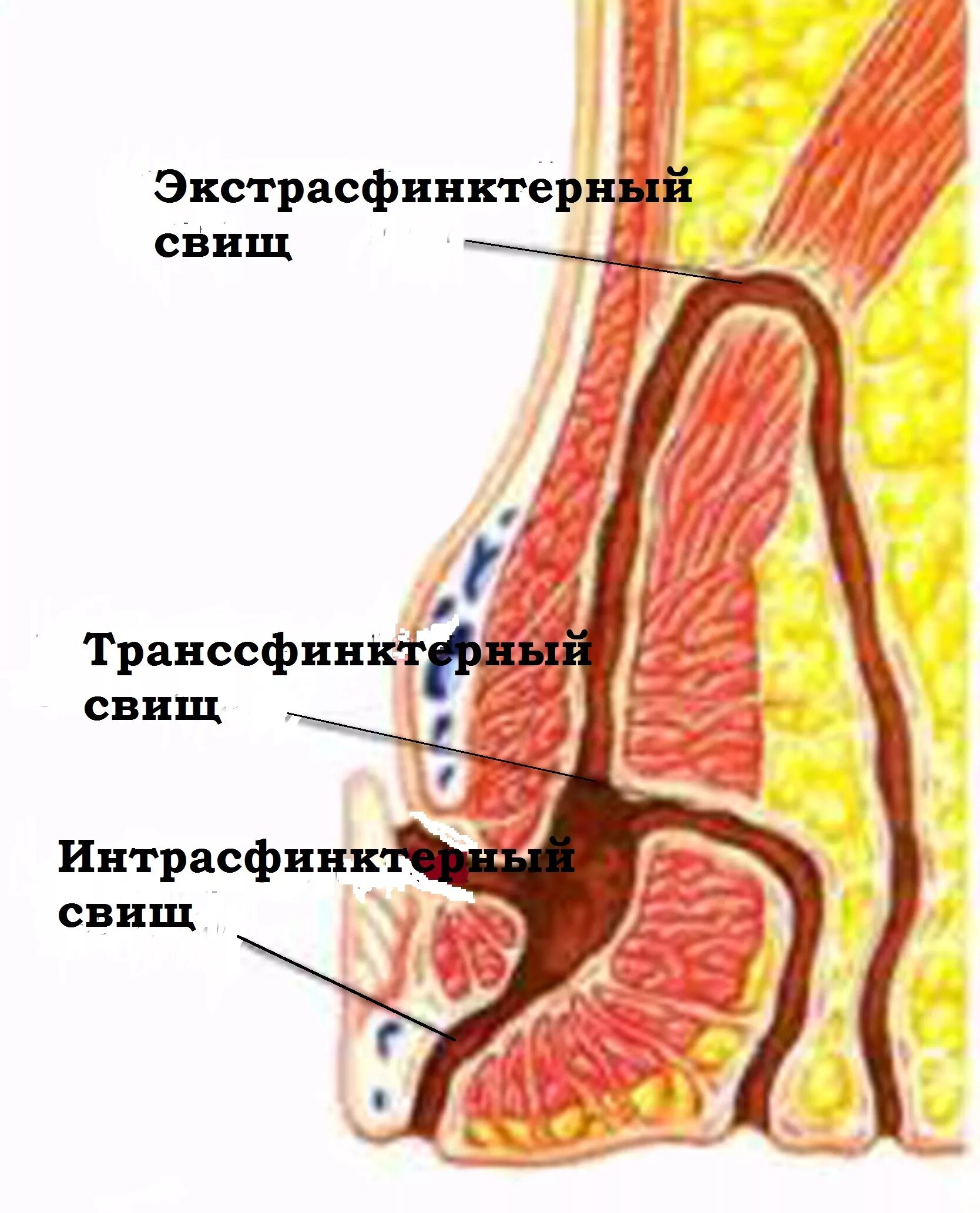 Интрасфинктерный свищ прямой кишки. Хронические параректальные свищи. Задний транссфинктерный прямокишечный свищ. Хронический парапроктит. Боли внутри заднего прохода