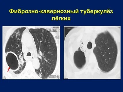 Кавернозный и фиброзно кавернозный туберкулез легких презентация