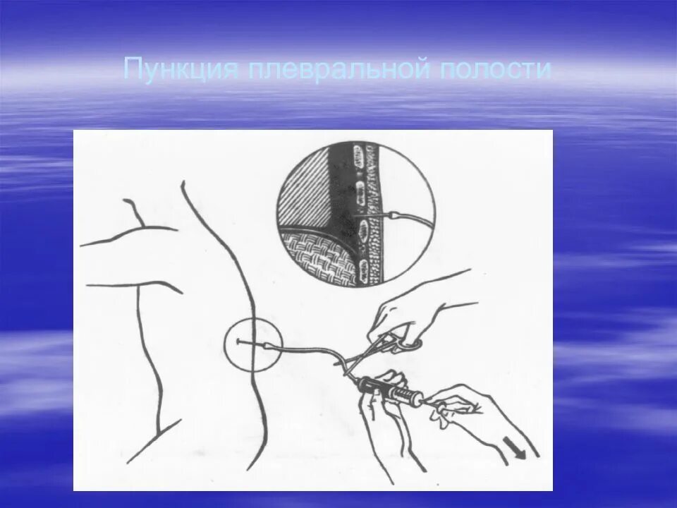 Пункция и дренирование плевральной полости. Спинномозговая плевральная пункция. Плевральная пункция технология.