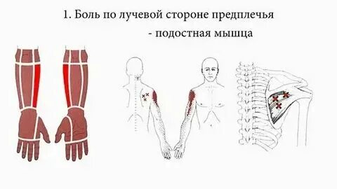 Боли в предплечьях обеих рук