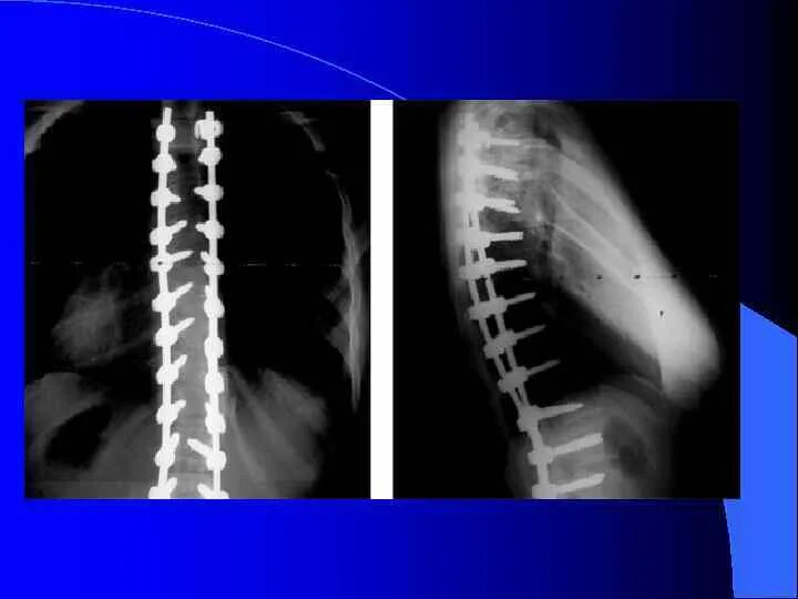 Сколиоз после операции рентген. 2-Х пластинчатый эндокорректор. Рентгенограмма коррекции сколиоза 2-х пластинчатым эндокорректором. 2-Х пластинчатый эндокорректор рентген. Конструкция позвоночника операция