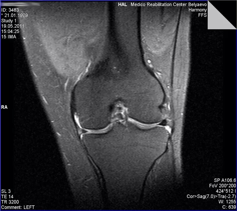 Снимки мрт повреждения мениска. Мрт коленного сустава разрыв мениска. Снимок мрт колена разрыв мениска. Травмы коленного сустава мрт снимки.