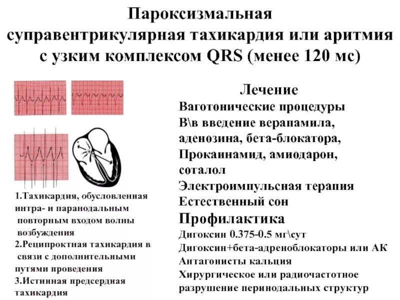 Пароксизм аритмии. Пароксизмальная аритмия на экг. Купирование пароксизма. Пароксизм аритмии. Наджелудочковая тахикардия с узкими комплексами qrs.