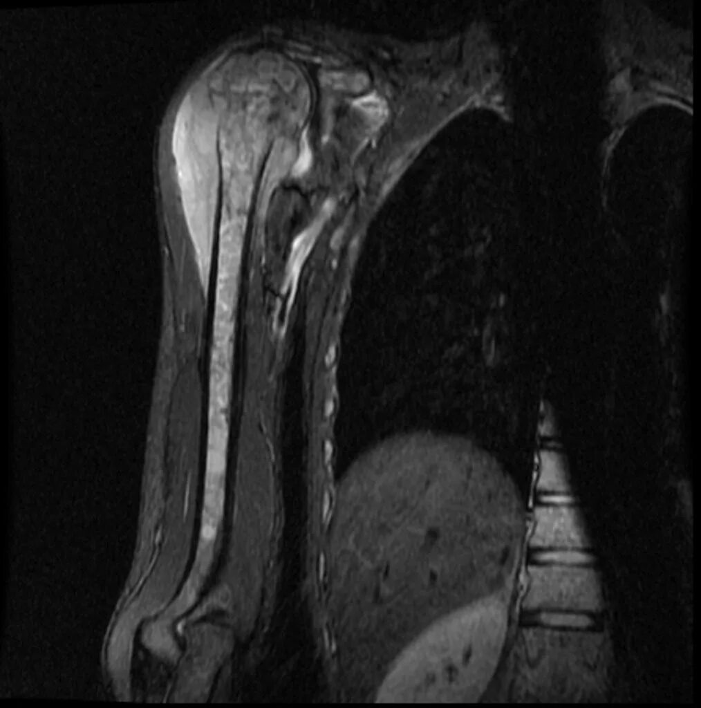 Sarcoma horror