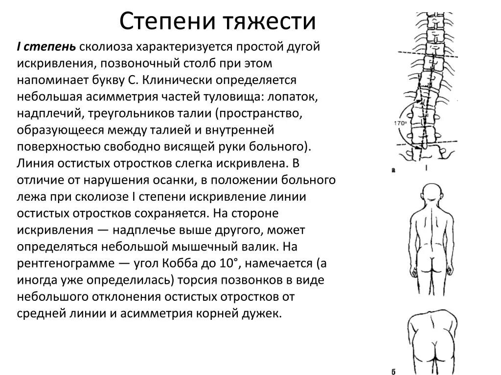 Сколиоз 2 степени это. Сколиоз 1 степени рентген. Сколиоз 3 степени угол Кобба. Сколиоз 1 степени рентген описание. Сколиоз 1 степени по чаклину.