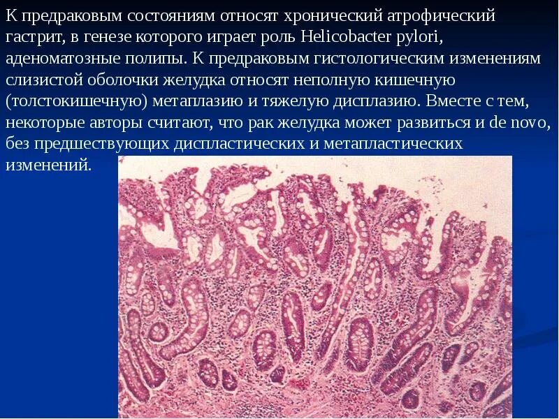 Изменение слизистой оболочки желудка. Хронический атрофический гастрит. Предраковые состояния желудка. Предраковые изменения слизистой оболочки желудка. Гистология при атрофическом гастрите.