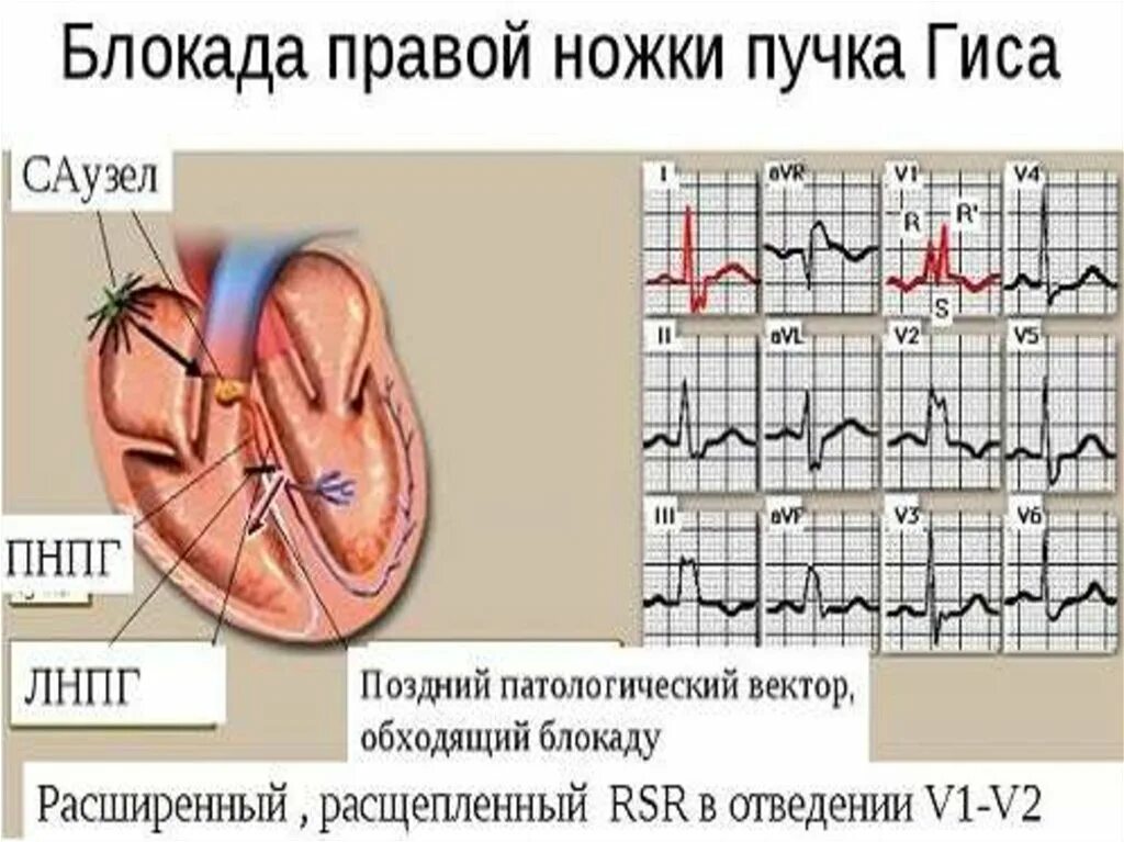 Нарушение блокады гиса. Блокада правой ножки. Блокада правой ножки пучка Гиса. Блокада правой ножки пучка. Пучок Гиса.