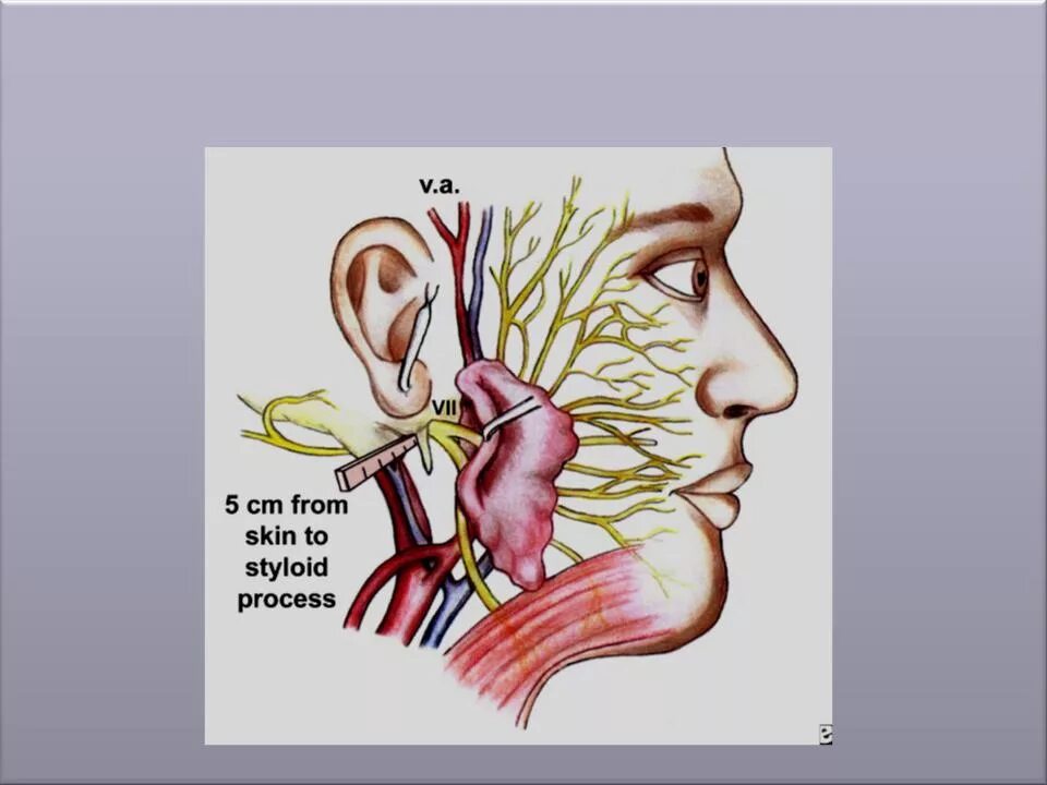 Неврит лицевого нерва анатомия. Лицевой нерв стоматология.