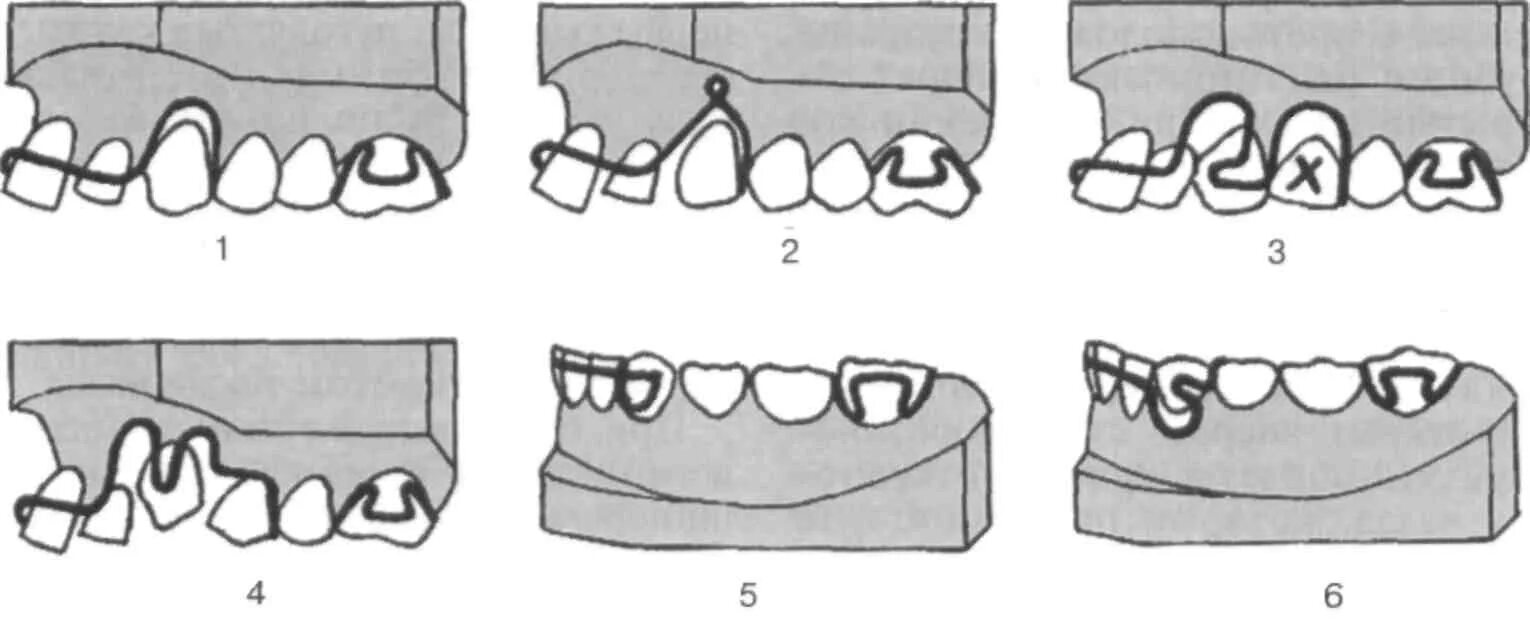 Изгиб зубов. Кламмер Адамса в ортодонтии. М образная вестибулярная дуга в ортодонтии. Вестибулярная дуга с м образным изгибом. Вестибулярная дуга на нижнюю челюсть с м-образным изгибом..