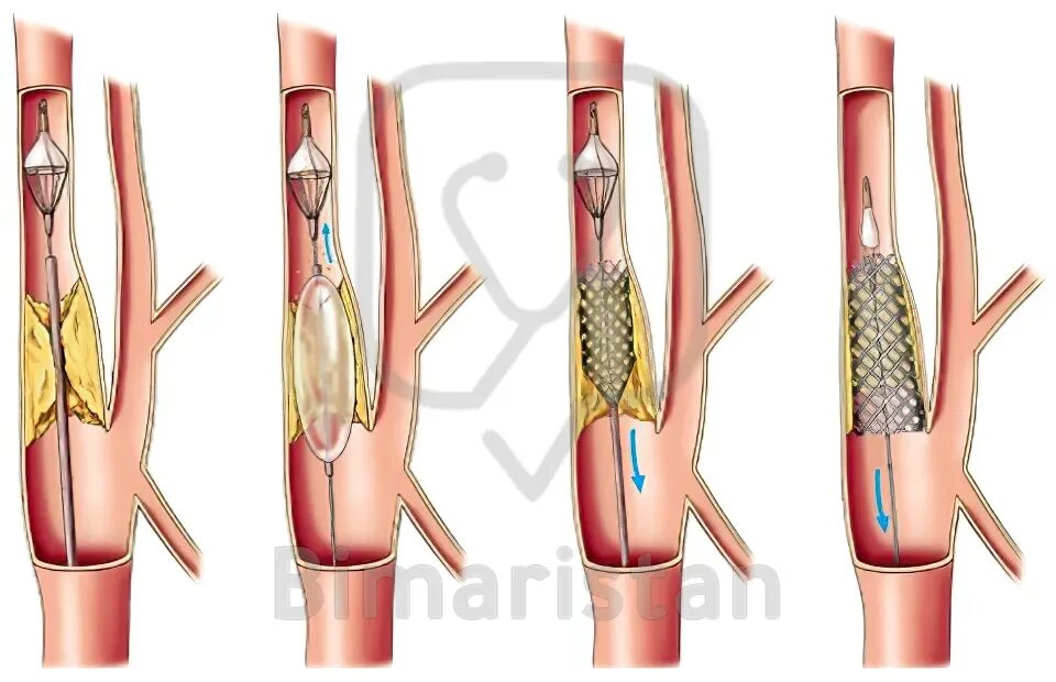 Стентирование сосудов сонной артерии. Стеноз внутренней сонной артерии стентирование. Стентирование сосудов ход операции. Баллонная ангиопластика сосудов шеи. Бляшка на шее операция