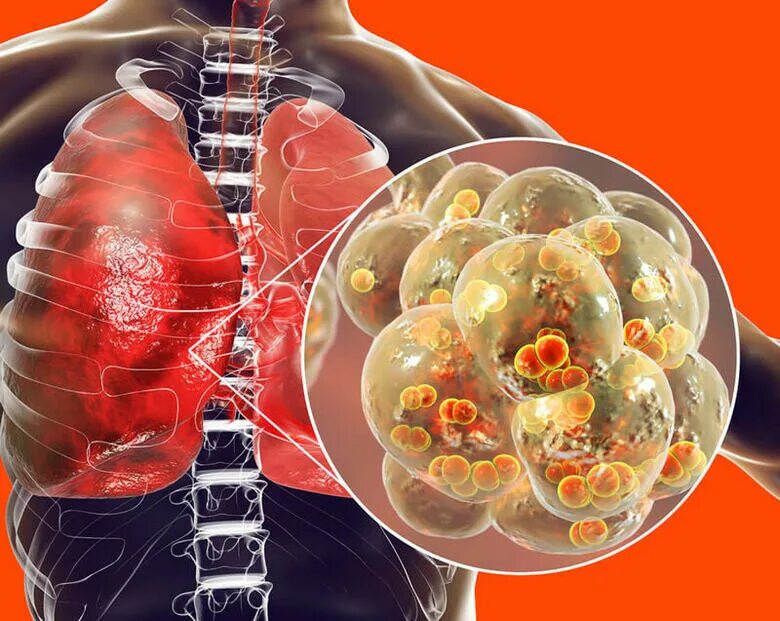 Файл:Main symptoms of infectious pneumonia.png - Википедия