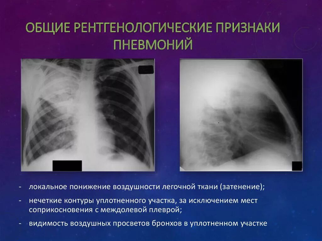 Болезни легких у детей. Долевая пневмония рентген. Крупозная пневмония рентген признаки. Правосторонняя очаговая пневмония рентген. Рентген признаки пневмонии.