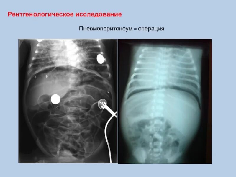 Коллапсотерапия при туберкулезе. Искусственный пневмоперитонеум. пневмоперитонеум при туберкулезе. наложение пневмоперитонеума при туберкулезе. идиопатический пневмоперитонеум.