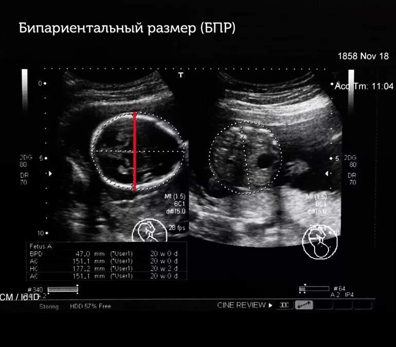 Окружность головы плода норма. УЗИ параметры головы плода. УЗИ 11 недель окружность головы плода. Ультразвуковая фетометрия плода норма. Норма бипариетального размера головы плода.