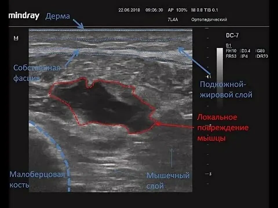 Узи мышц делают. Разрыв икроножной мышцы узи. надрыв мышцы на узи. надрыв икроножной мышцы на узи. разрыв мышцы на узи.