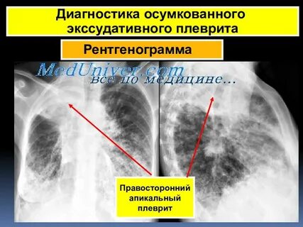 Плеврит диагностика