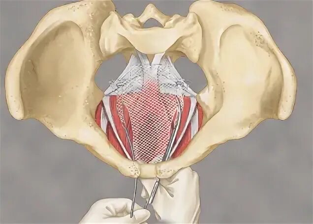 Подтягивание матки. Сетчатый эндопротез пролапс. Сетчатый имплант при ректоцеле. Хирургическая реконструкция тазового дна.