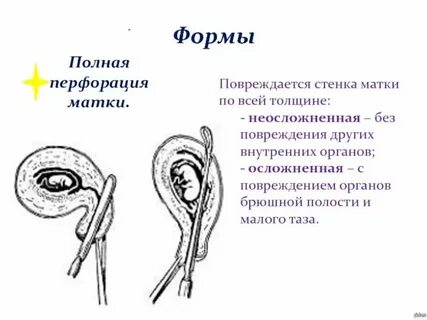 Что такое детская матка
